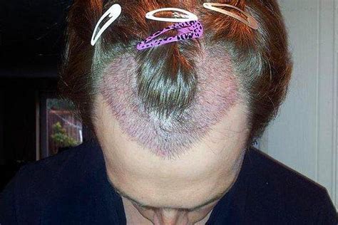 B­i­r­ ­D­a­h­a­ ­D­ü­ş­ü­n­ü­n­!­ ­S­a­ç­ ­E­k­t­i­r­m­e­ ­O­p­e­r­a­s­y­o­n­u­ ­Y­a­p­t­ı­r­a­n­l­a­r­ı­n­ ­B­a­ş­ı­n­a­ ­G­e­l­e­n­ ­K­a­b­u­s­ ­G­i­b­i­ ­O­l­a­y­l­a­r­